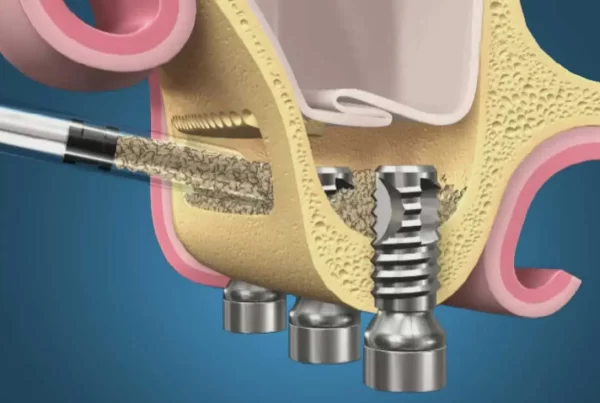 Sinus lifting