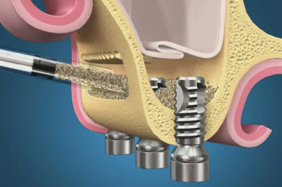 Lifting des sinus : un guide complet pour améliorer le succès des implants dentaires