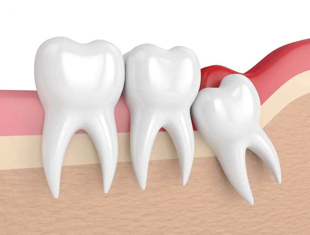 Wisdom Tooth Removed: What You Need to Know