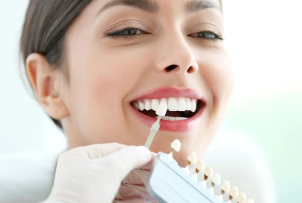 Dental veneers