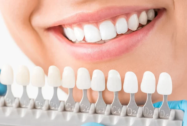 Dental veneers