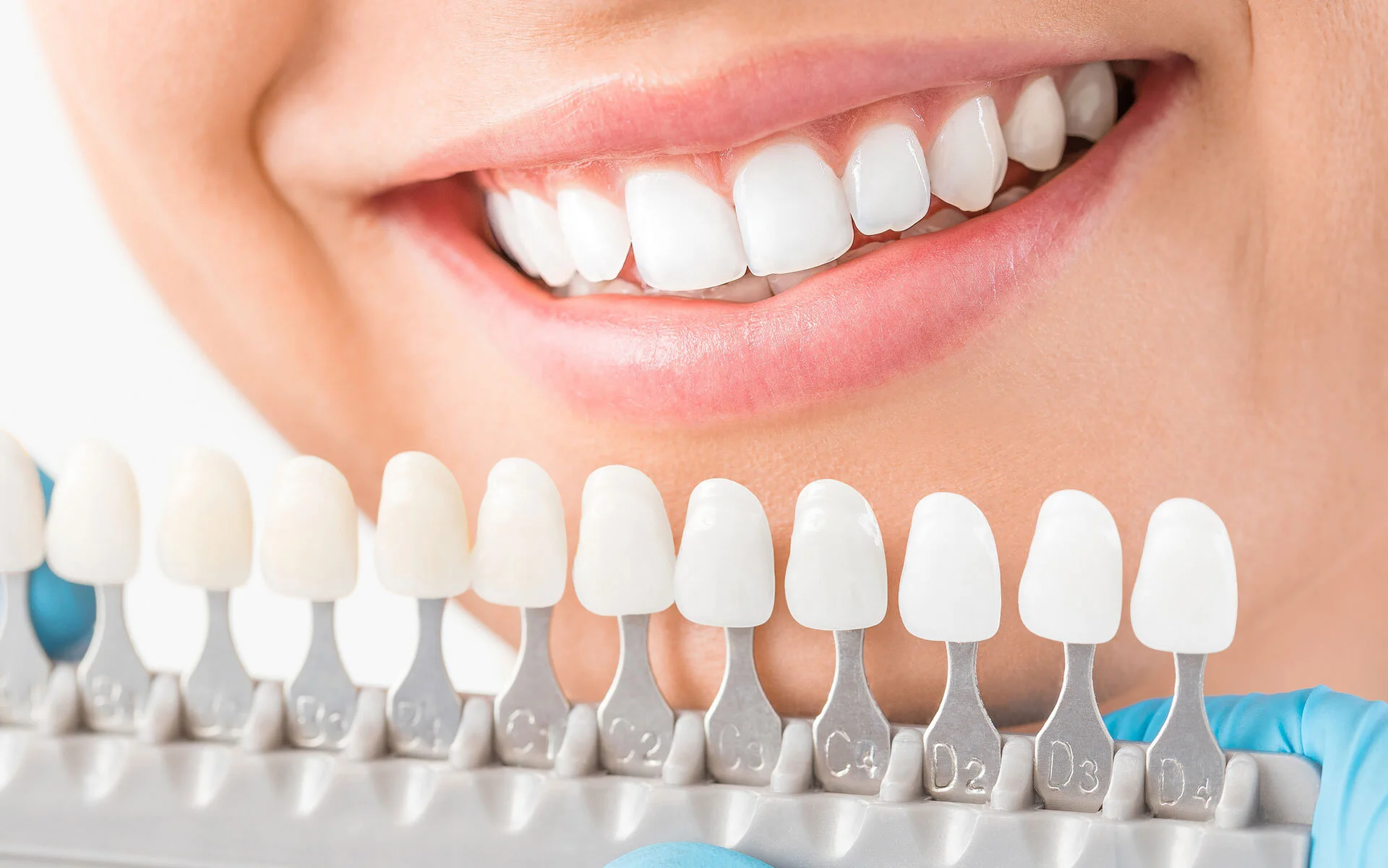 Faccette dentali: la soluzione perfetta per un look impeccabile