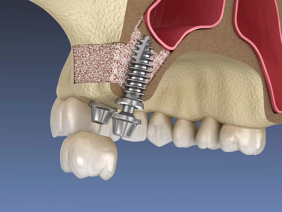 Sinus lifting