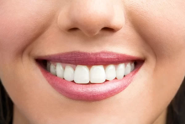 Smile design