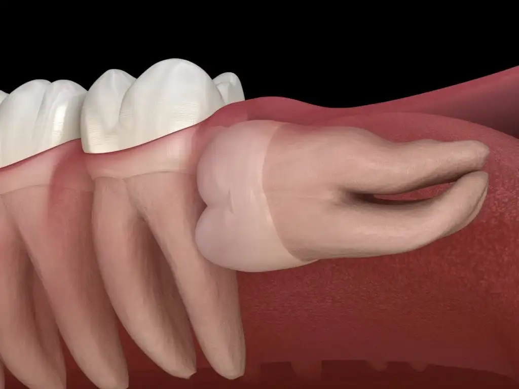 Wisdom tooth removed