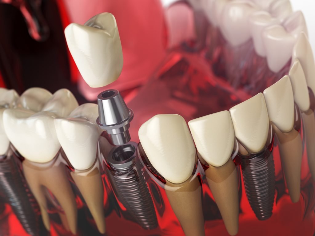 Diş implantı çeşitleri