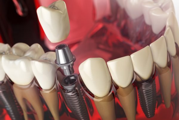 Diş implantı çeşitleri