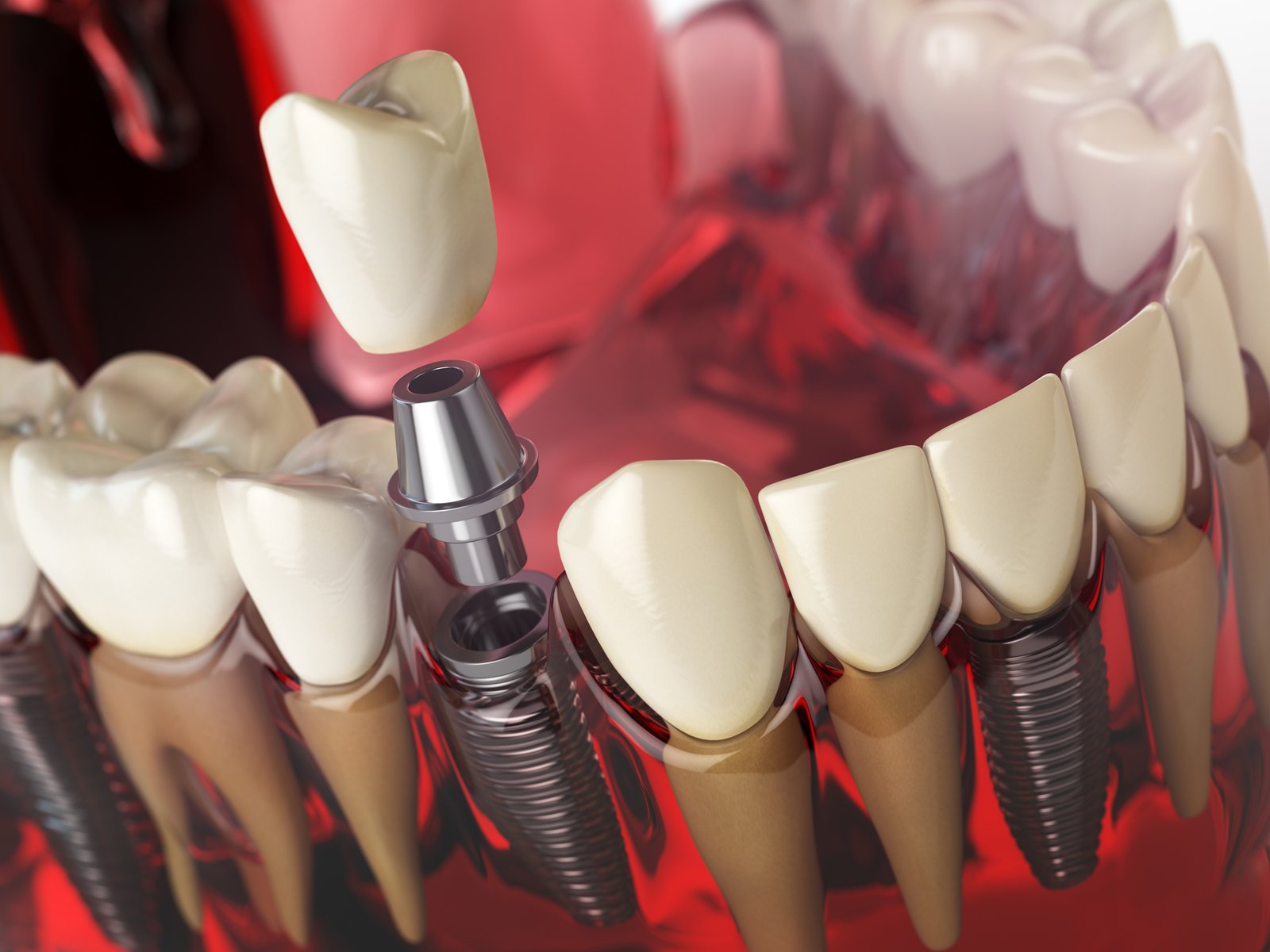 Diş implantı çeşitleri