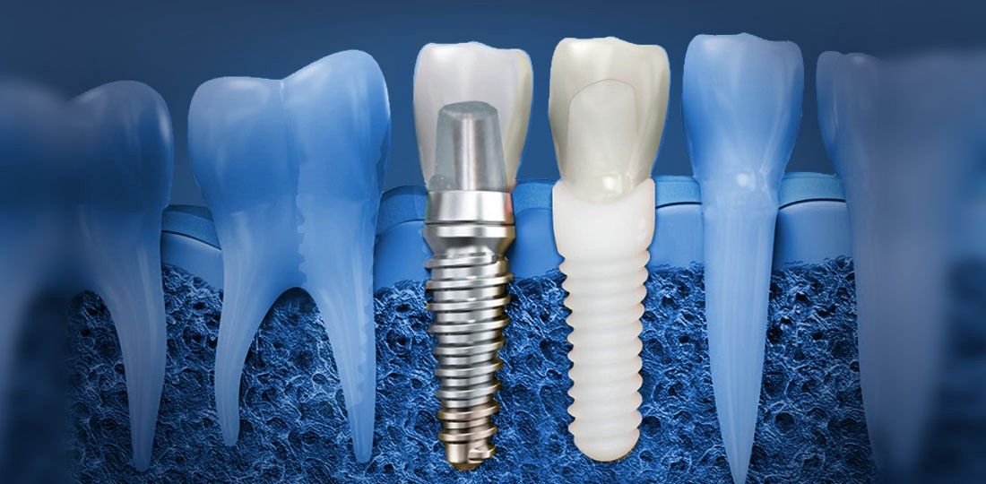 Types d'implants dentaires